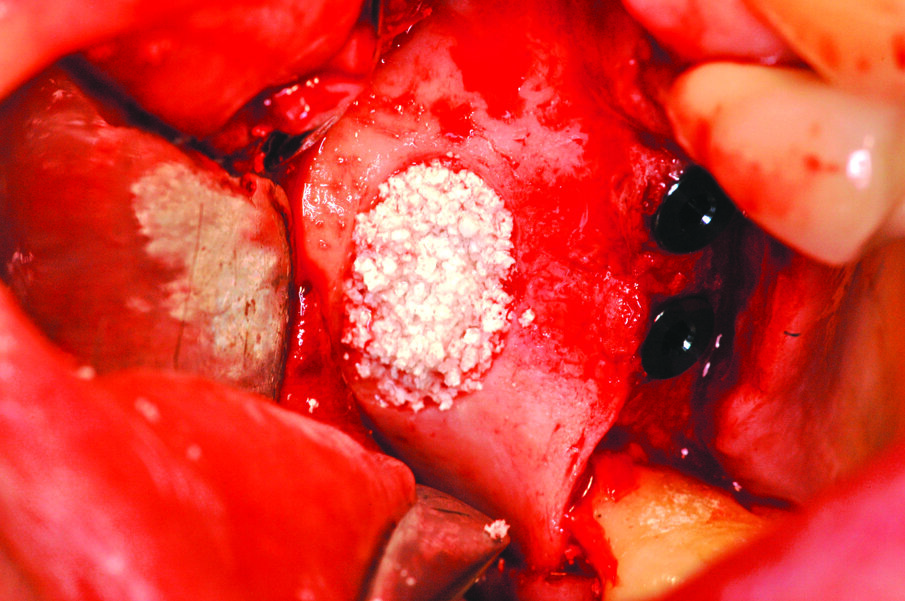Fig. 11_Foto del completamento del riempimento del seno con biomateriale.