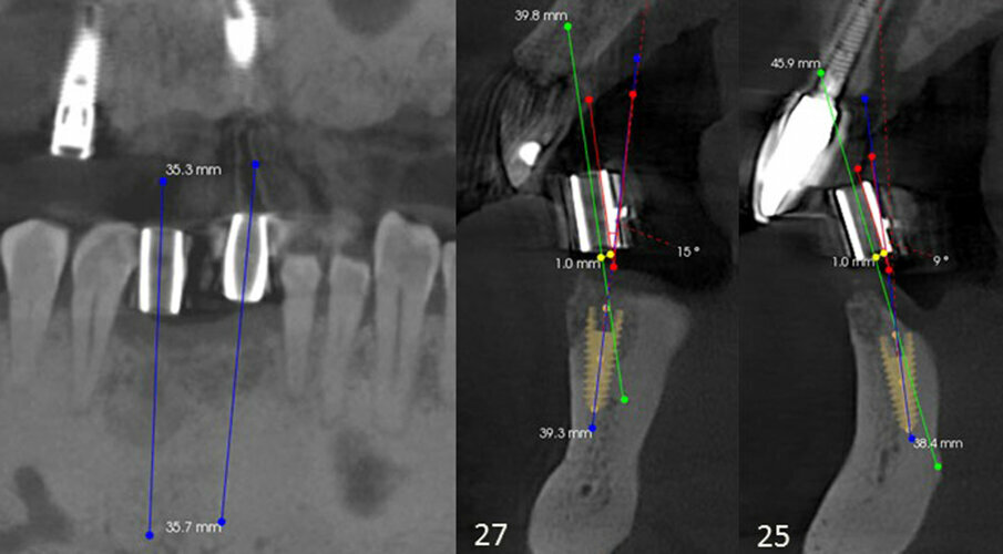 Figs. 5a–c: CBCT views showing orientation of the diagnostic guide sleeves in relation to the bone present (green line), indicating correction required on both planned sites to have implants placed within the arch. The red line indicates the angle correction, and the yellow line indicates the offset measurement to the facial and lingual aspects. The blue line indicates the newly planned axis of the implant.