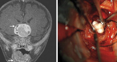 Chirurghi trovano denti nel tumore cerebrale di un bambino