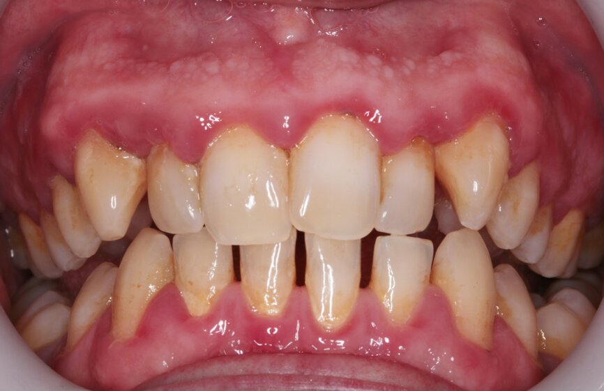 Fig. 2: Pre treatment smile
