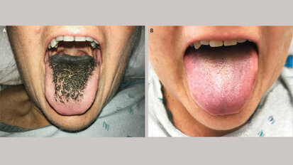 Rare case of black hairy tongue reported
