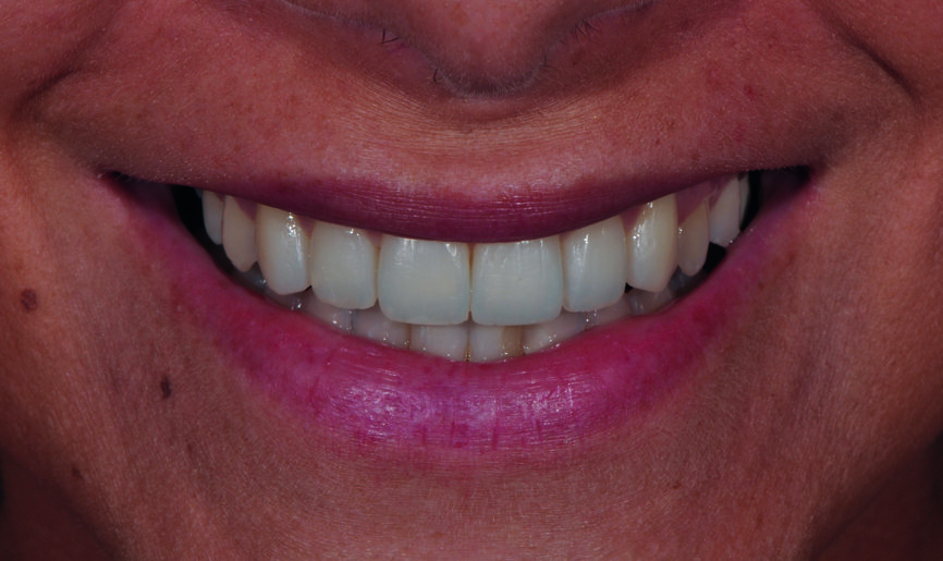 Fig. 6 : a) Gros plan du sourire après la fermeture du diastème avec le composite Essentia (GC). 