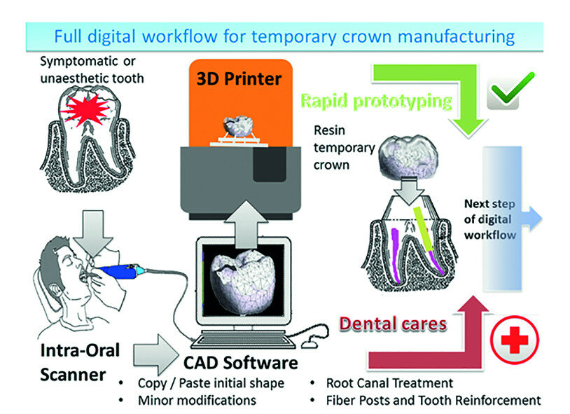 Fig. 23: Fully digital workflow for temporary 3D printed crown
manufacturing. Dental treatment (caries treatment, root canal therapy, post and core, etc.) can be done during 3D printing of the temporary crown.