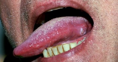 舌癌：研究者らが早期診断の有力なマーカーを発見