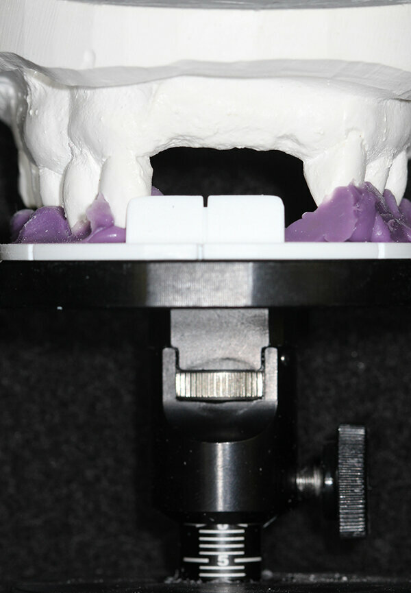 Fig. 4: Occlusal stand with index tray and dental model mounted.