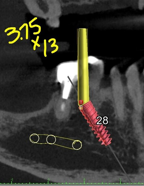 Figs. 5a–e: Implant planning for the mandibular arch with straight and angled multi-unit abutments.