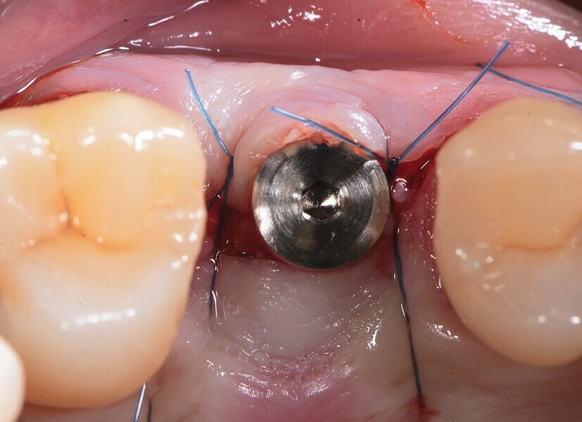 Fig. 9 : Fin du traitement chirurgical. Implant deux pièces en céramique au niveau tissulaire. 