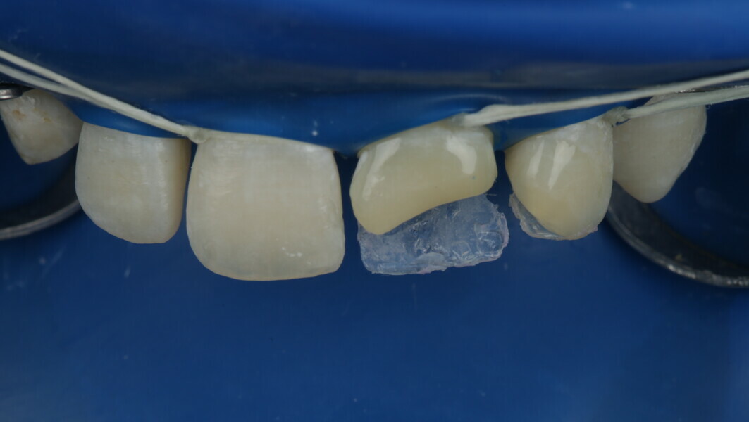Fig 18: With the final palatal shape it is easy to foresee the final shape for the final composite resin restoration.