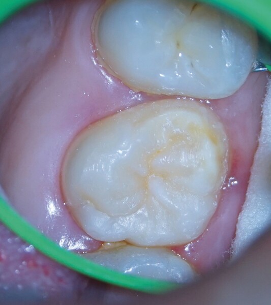 Fig. 5b : Deux semaines après l’intervention. Un tissu parodontal sain est visible autour de la dent transplantée après le retrait de la contention. 