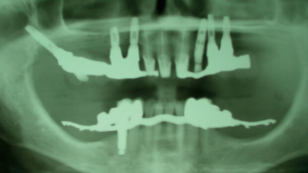 Caso clinico di odontoiatria forense relativo a un piano riabilitativo complesso implantare