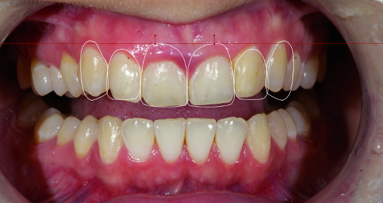 Digital implantology— Predictable aesthetics and functional results