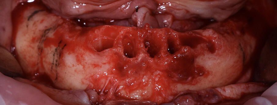 Fig. 4 - Rimozione elementi dentari residui e scheletrizzazione con visione dei mentonieri.
