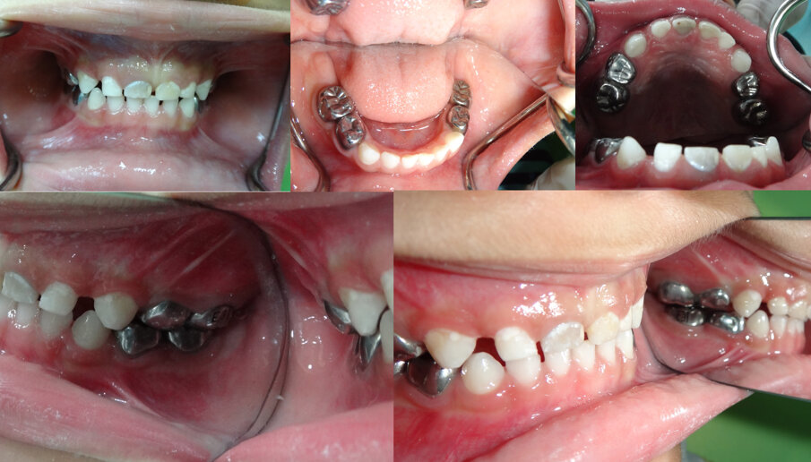 Figures 3 (a, b, c, d & e): Immediate post- treatment completion images. All Es and Ds were restored using the HT. Notice the good gingival status. Using the primary canines as a guide, opening of the bite is noted in Figures 3 (d & e).  51 became discoloured with no sinus present. No known trauma. We opted to manage 51 conservatively as x-ray showed no pathology. The patient by this time had no experience of LA, avoided GA and was gradually becoming cooperative.