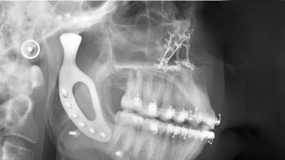 Melbourne surgeons implant Australia’s first 3-D-printed mandibular joint