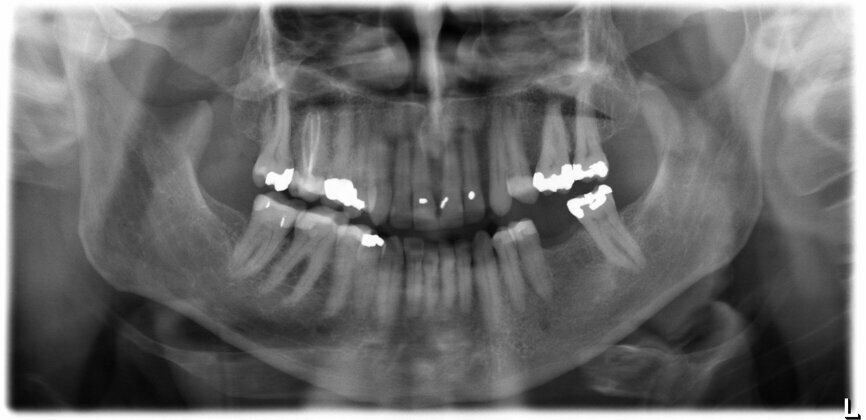 Fig. 1: Panoramic radiograph confirming the well-maintained anatomical conditions one year after tooth extraction.