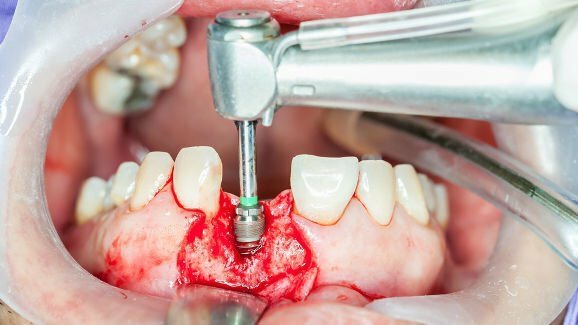 Dental implants market in China to grow at a CAGR of 28.26 per cent