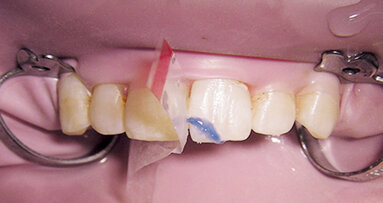 Léčba traumat zubů – doporučené postupy