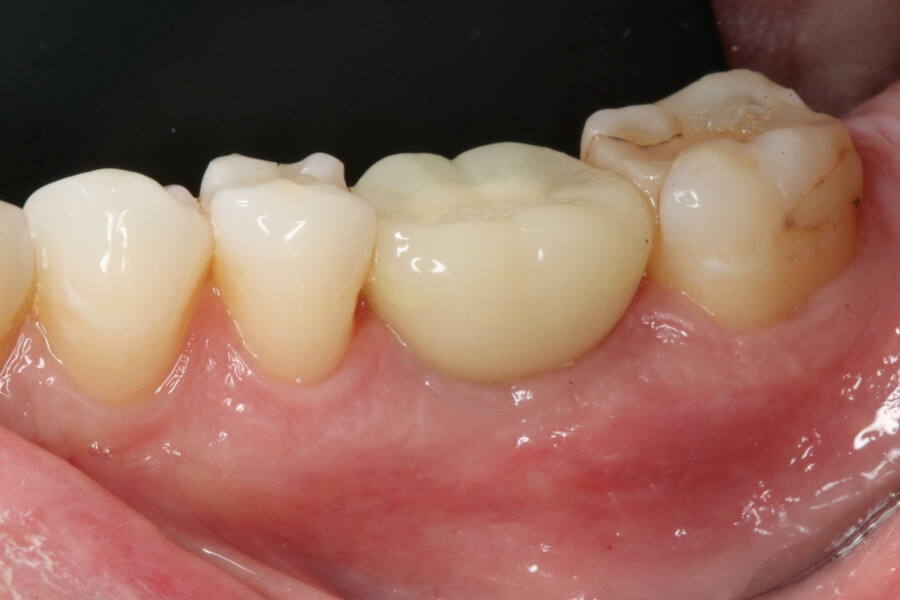 Fig. 15: Healed site with provisional crown eight weeks after implant placement.