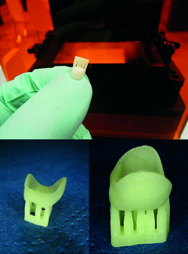 Fig. 5: 3D printing of the temporary crown with E-Dent 400—
biocompatible, CE-certified Class IIa (described as generally invasive products with a short-term application, validated up to one year in the mouth by the manufacturer) and 3D printed support structure.
