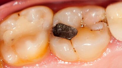 Studija Evropske komisije preporučuje zabranu zubnog amalgama