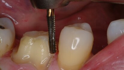 Zastosowanie narzędzi Great White Ultra Carbide w preparacji zębów pod korony