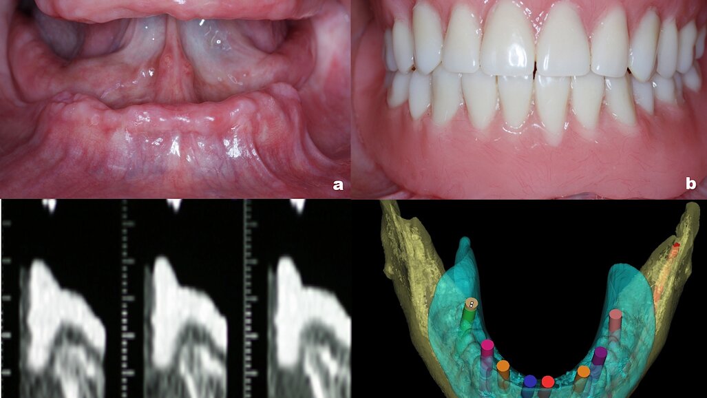Principios de la planificación digital en implantología oral