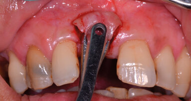 L’adherence al trattamento chirurgico, dopo l’igiene orale professionale. Case report