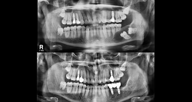 Enucleación de quiste dentígero mandibular y rehabilitación con implantes dentales
