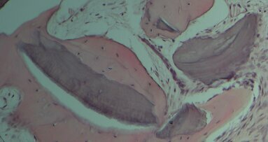 Aumento della cresta alveolare con tecnica “Bone into Bone”: analisi istomorfometrica