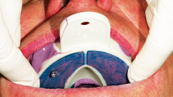 Advances in dental implant impressions