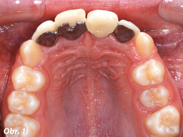 Obr. 1: Situace před ortodontickým ošetřením – adhezivní můstek s náhradou zubu 21