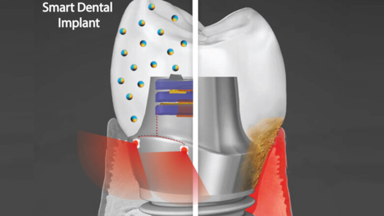 Researchers developing  antibacterial smart dental implant that uses phototherapy