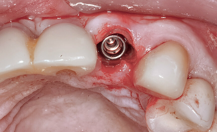 Fig. 10: The
implant was placed into the osteotomy through the template using a special manufacturer-specific carrier.
