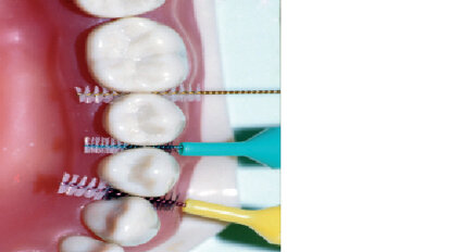 Aktuální koncepty prevence gingivitidy a parodontitidy
