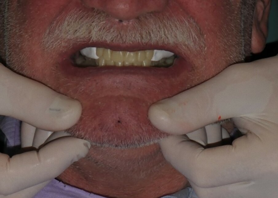 Fig. 8_Masticoni adattati e testati in bocca al paziente.