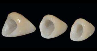 Entre BOPT et BTA : Une étude de cas sur le remodelage du contour gingival de restaurations dento-portées au moyen de couronnes provisoires en résine.