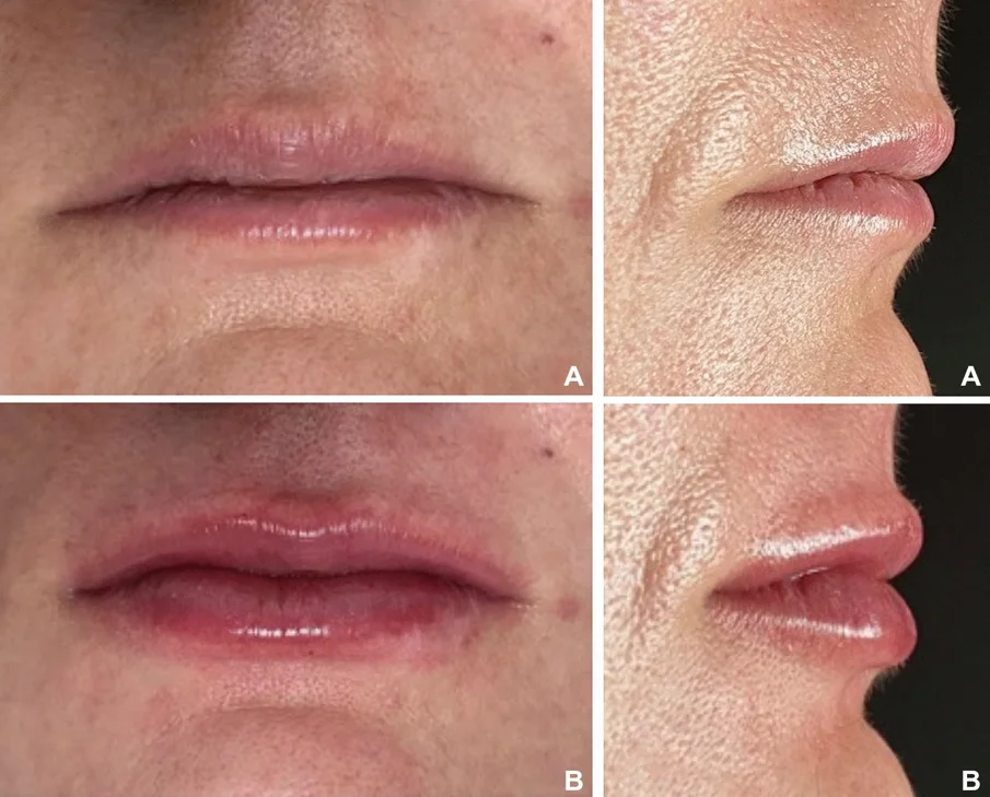 Pacijentica iz skupine s tanjim usnama (a) prije punjenja usana i (b) deset dana nakon punjenja usana. (Slika: De Queiroz Hernandez i sur., licencirano pod CC BY 4.0)