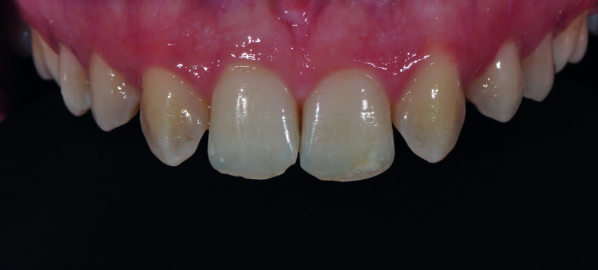 Fig. 1b : Gros plan du sourire après la fermeture orthodontique. Il faut noter l’aspect jaunâtre des canines, les grandes embrasures des incisives et la ligne gingivale égalisée. 