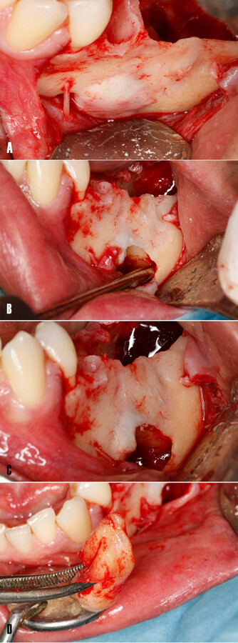 Figura 7. ExtracciÃ³n de los dientes impactados. Imagen intraoral â vista lateral. A) NÃ³tese el ensanchamiento de la cortical vestibular y proximidad de la emergencia del nervio mentoniano. B) Se realiza una ostectomÃ­a a manera de ventana, para asÃ­ acceder a la porciÃ³n radicular del diente 3.6 para su extracciÃ³n con ayuda de un elevador recto. C) El diente 3.6 ha sido desplazado. D) Diente fuera de boca tras su extracciÃ³n.