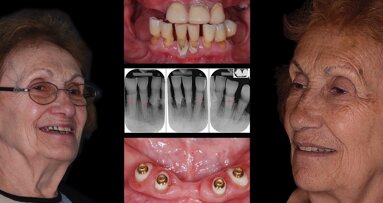 Colocación de sobredentadura sobre raíz natural del diente en paciente edéntulo