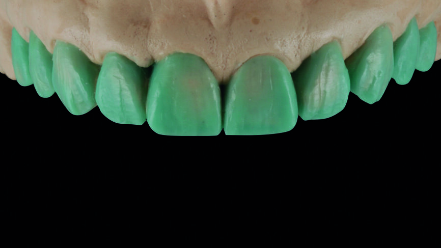 Fig. 4 : Warm-up sur le modèle en plâtre pierre en vue du traitement de restauration des dix dents antérieures. 