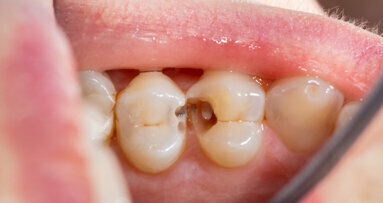 Study offers new insights into periodontal disease and body’s protective response