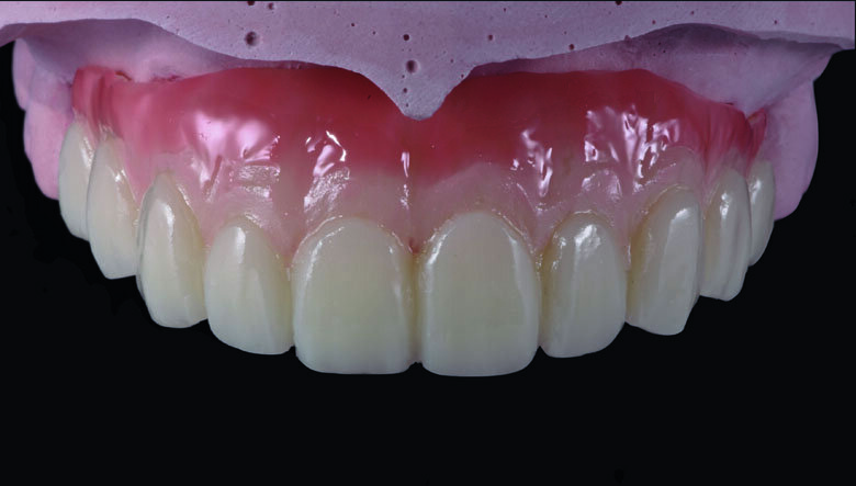 Fig 15. Ceramage GUM Dark (GUM-D) was applied on the attached gingiva area to the buccal flange