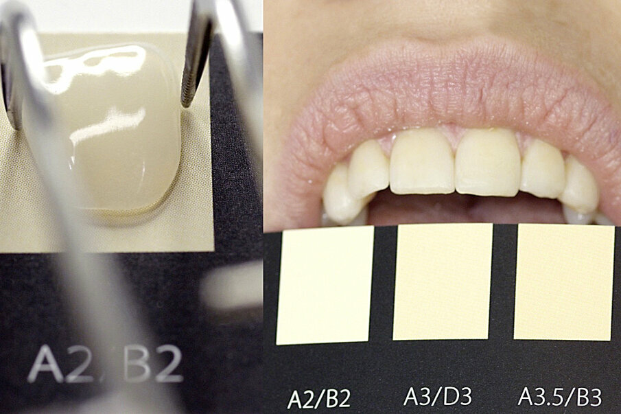 Fig. 6: Integration into the natural tooth row after completion
