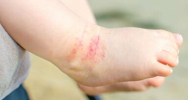 Crianças com dermatite atópica têm maior risco de cárie mais tarde na vida