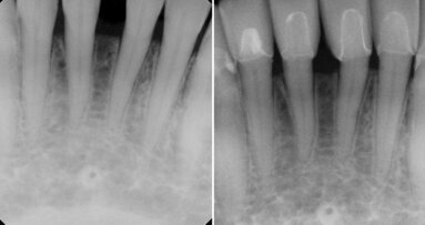 The importance of gingival health in a functional cosmetic case