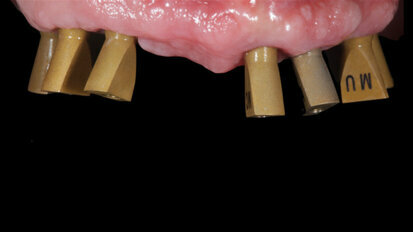 Dental implant abutment design is “a small stone in the whole mosaic”