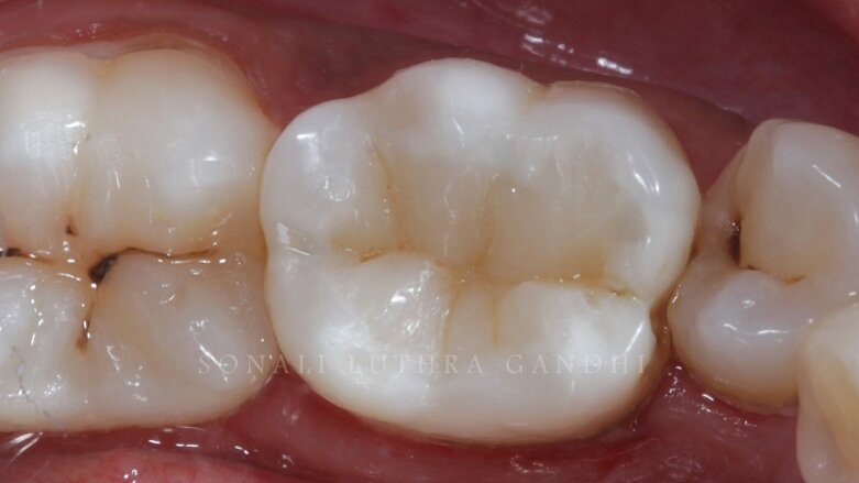 Cuspal layering technique to produce aesthetic posterior composite restorations – A case report