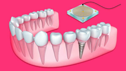 新しいセンサーが歯科インプラント周辺の骨の成長を監視