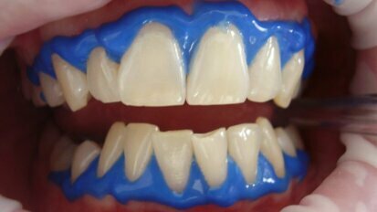'Tanden bleken' populairste zoekopdracht